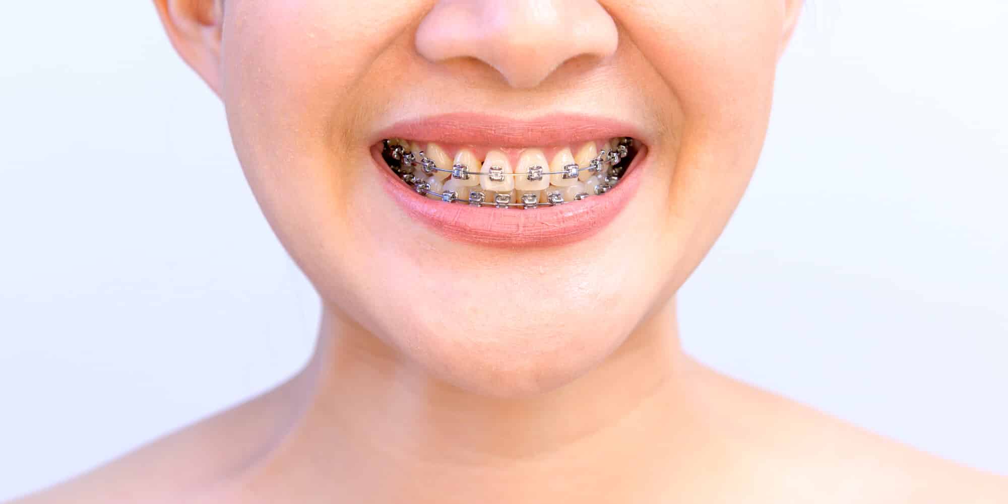 orthodontic treatment